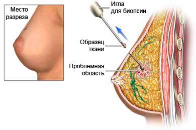 Трепан-биопсия молочной железы