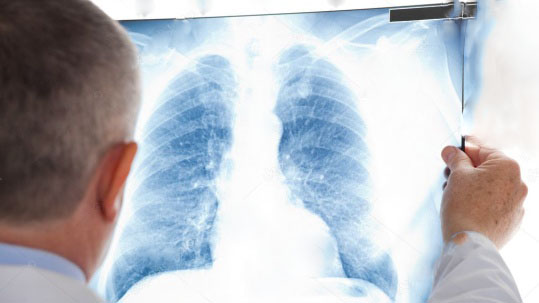 Рентгенография лёгких