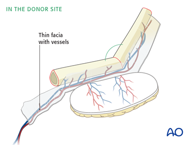 Трансплантат с донорскими сосудами.png
