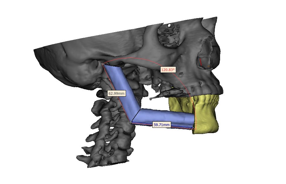 Формирование контуров нижней челюсти из малоберцового аутотрансплантата.JPG