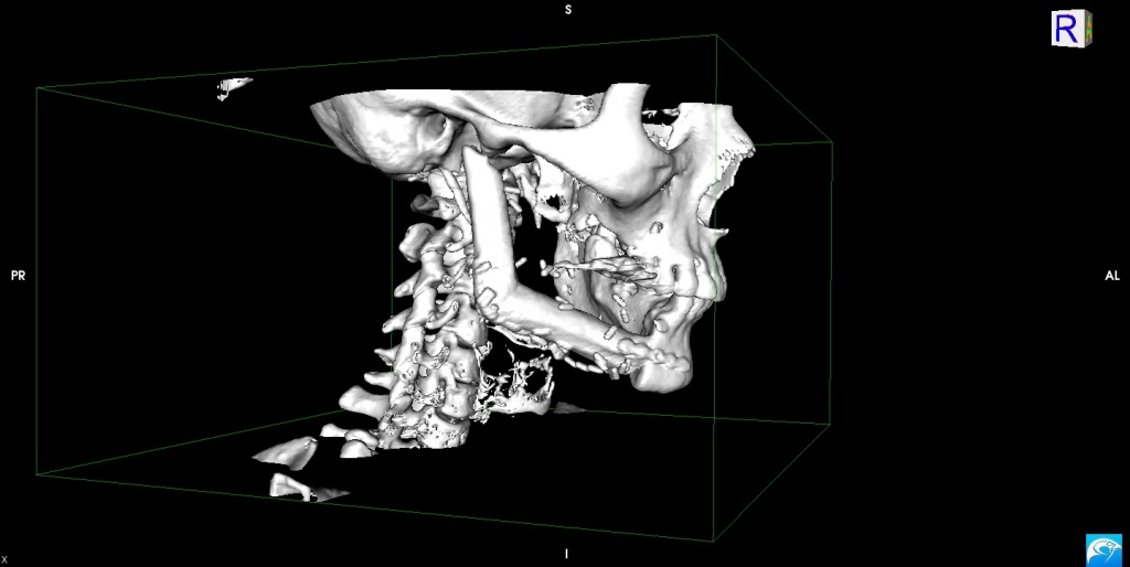 КТ после резекции нижней челюсти и реконструкции малоберцовым аутотрансплантатом.jpg