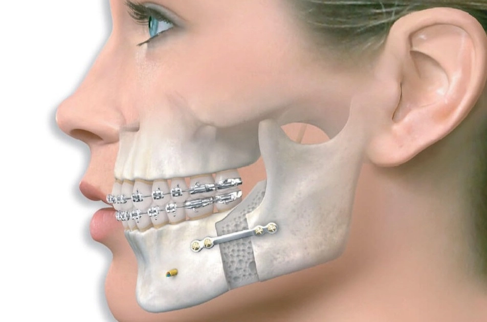 Jaw correction surgery