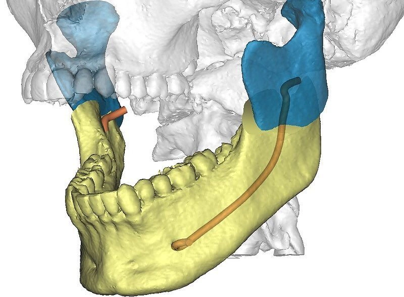 О технологии цифрового 3D-планирования в челюстно-лицевой хирургии