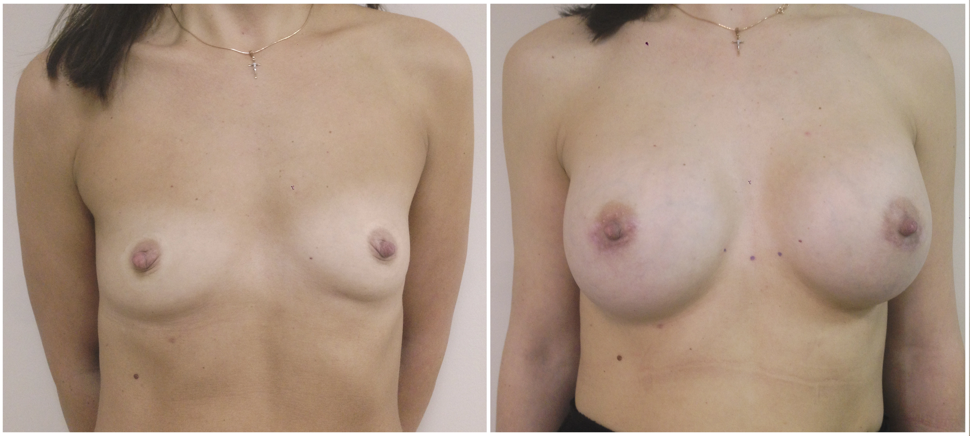 Трансаксиллярное увеличение груди имплантами. 6 месяцев после операции. Хирург:  Коваль Сергей Николаевич