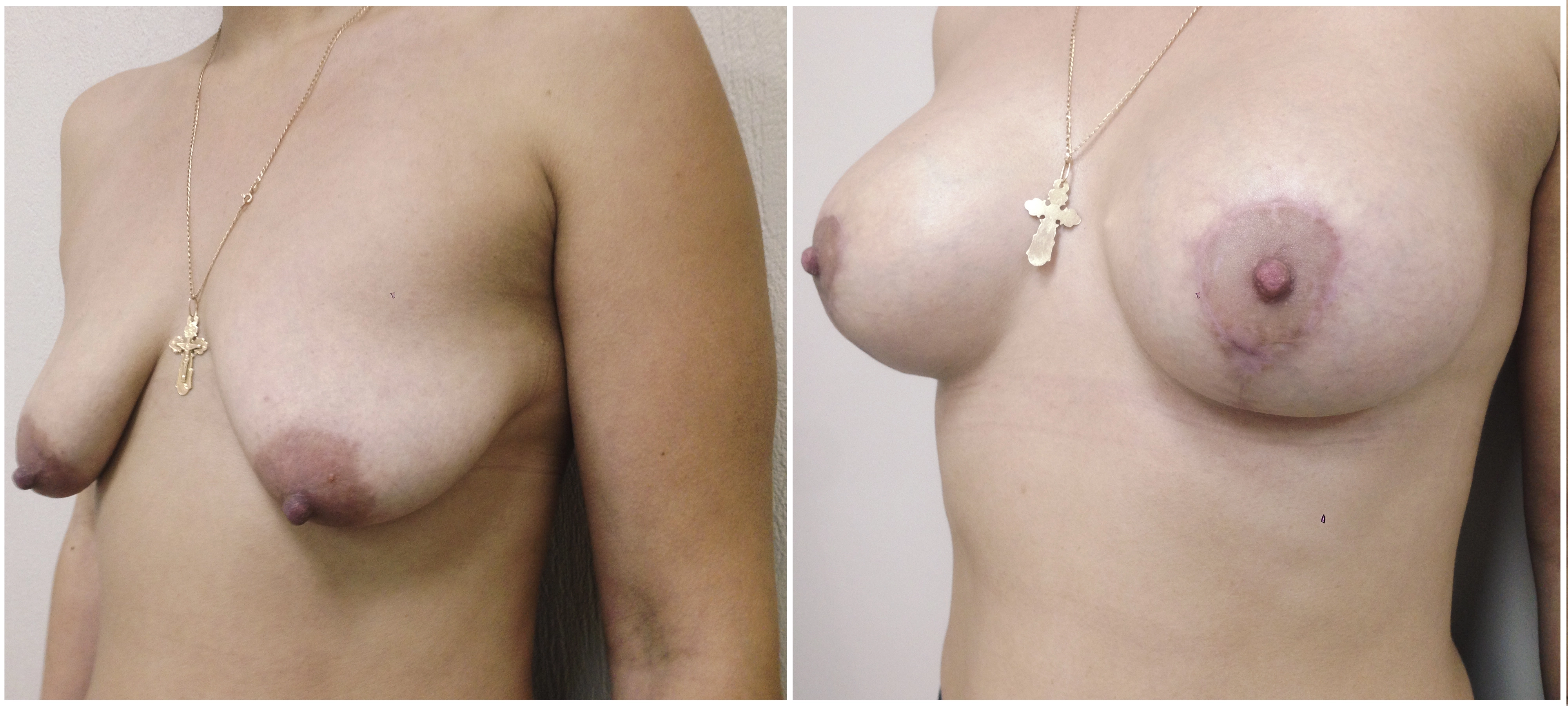 Трансаксиллярное увеличение груди имплантами. 7 месяцев после операции. Хирург:  Мазур Андрей Евгеньевич