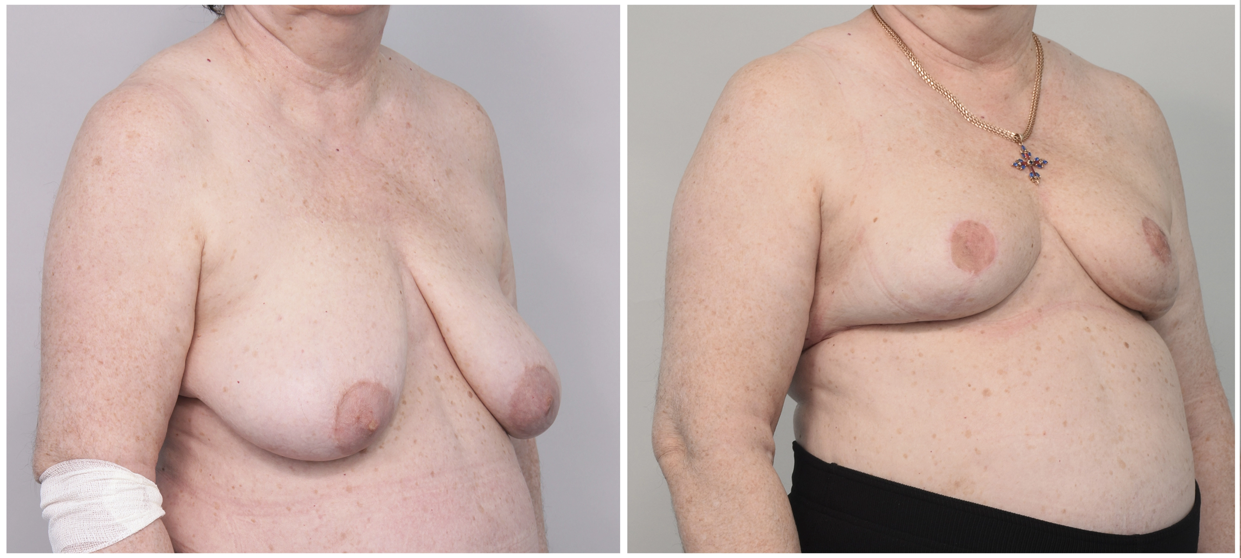 уменьшение груди у женщин причины фото 39
