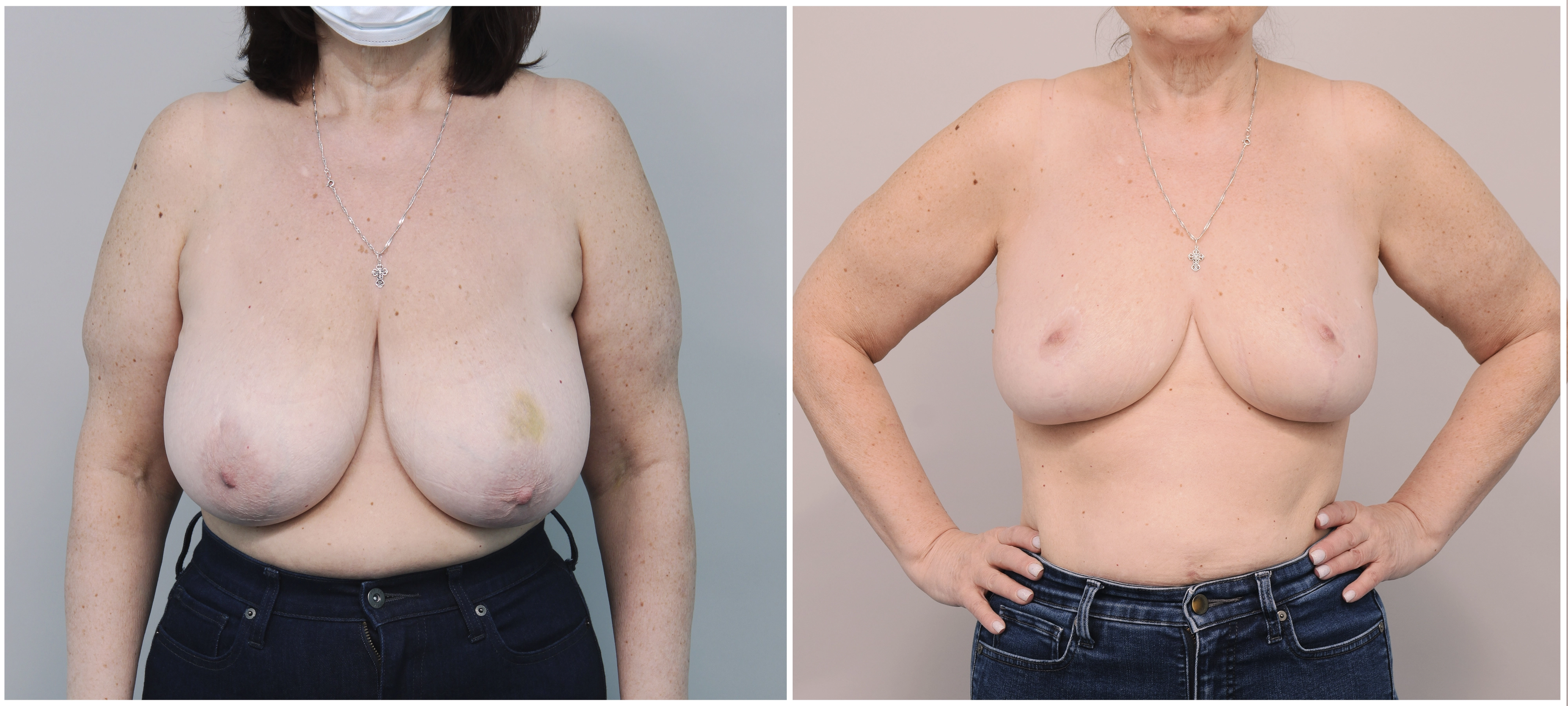 жжение в левой груди женщин фото 107