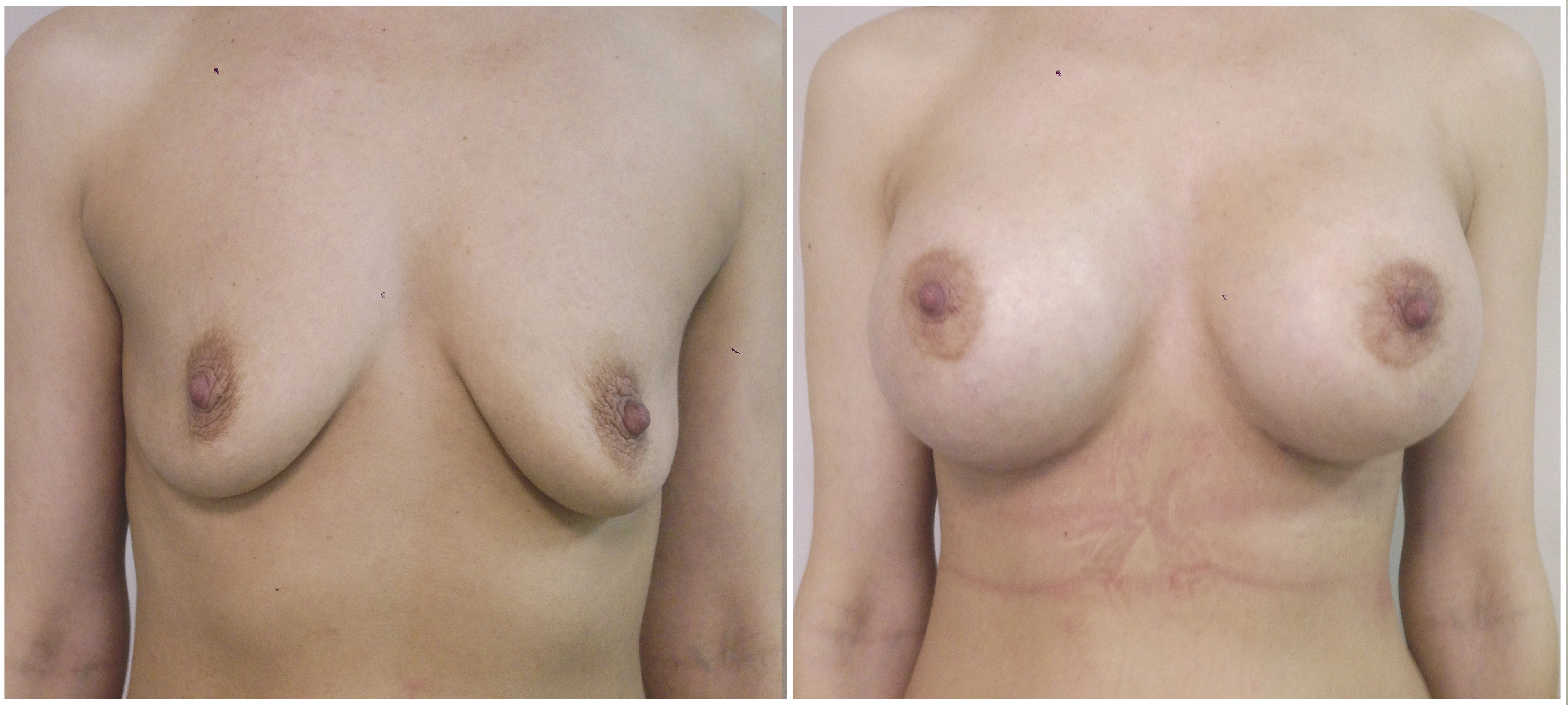 Трансаксиллярное увеличение груди имплантами. 6 месяцев после операции. Хирург:  Коваль Сергей Николаевич