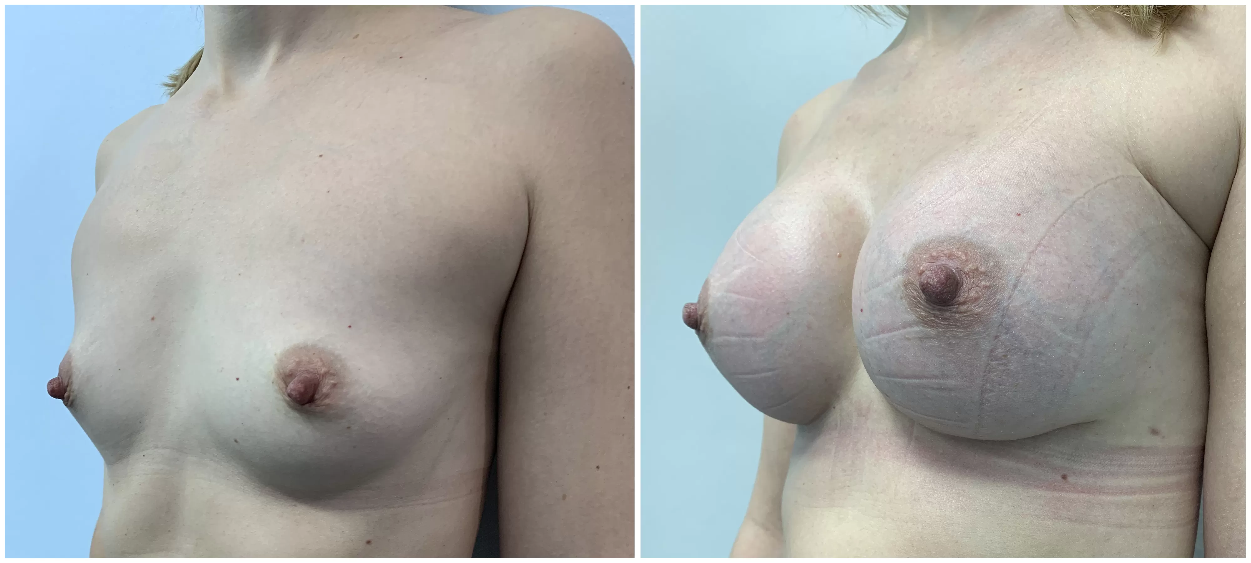 Трансакциллярное увеличение груди имплантами. 6 месяцев после операции. Хирург:  Коваль Сергей Николаевич